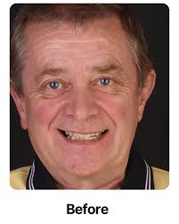 🌎 Hoy compartimos el testimonio de Colby Mosier, quien vino desde los EEUU  para transformar su sonrisa con nosotros. 🇺🇸✨ ¿Te gustaría mejorar tu  salud bucal y lucir una sonrisa radiante? 💬