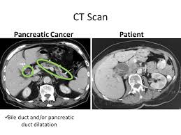 Using magnetic waves, a scanner creates detailed images of the abdomen, in particular the area around. Pancreatic Cancer Ct Scan Images Ct Scan Machine
