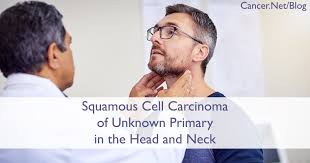 Oral cancers are highly prevalent, associated with a high death rate and much rarely found on the cheek. Head And Neck Cancer An Introduction Cancer Net