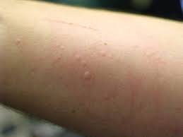 Why Do I Get Hives Chronic Hives Hives Causes Urticaria