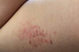 Bruise bleeding fracture fainting shock sunstroke poisoning burns texts for additional ambulance person: Leukemia Symptoms You Shouldn T Ignore The Healthy
