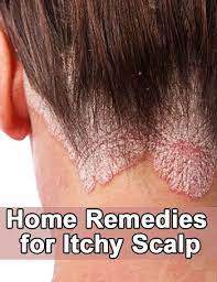 Home Remedies For An Itchy Scalp Hair Remedies Scalp Treatment Diy Dry Scalp Remedy