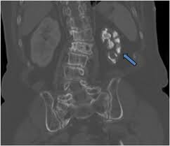 Image result for Genitourinary Tuberculosis
