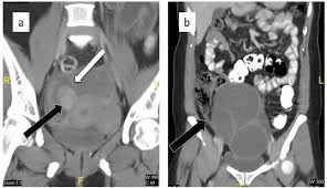 Rabe2 (dggef e.v.), m in the last few years, considerable progress has been made understanding endometriosis and developing diagnostic procedures and therapeutic options. Commonest Mimicker Of Ovarian Cancer Is Ovarian Endometriosis A An Download Scientific Diagram