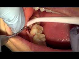 Pulling Wisdom Tooth Wisdom Teeth Wisdom Teeth Removal Wisdom Teeth Removal Procedure