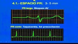 Los potenciales bioelectricos son realmente potenciales iónicos producidos como resultado de la actividad electroquímica de ciertos tipos especiales de células. Interpretacion Del Electrocardiograma Youtube