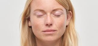 Image result for xantelasma