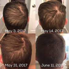 Loss Of Hair May Be Irregular If You Are Losing Greater Than 100 Hairs A Day This Might Cause A Basic Thinning Of Hair Loss Remedies Stop Hair Loss Hair Loss