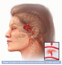 Toate durerile despre care am spus pana acum nu au fost constante. Anevrismul Cerebral Durerile De Cap Puternice AnunÈ›Äƒ Umflarea È™i Ruperea Unui Vas De Sange Din Creier