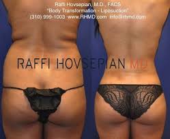 Body Transformation By Plastic Surgeon Dr Raffi Hovsepian This Patient Underwent Dr Hovsepian S Advanced Mommy Makeover Surgery Liposuction Plastic Surgery