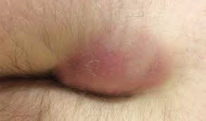 Image result for Perianal Abscess