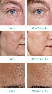 Best At Home Microdermabrasion Machine 2015 Pick And Review Microdermabrasion Microdermabrasion Machine Home Microdermabrasion