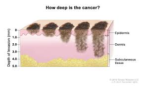 Examples of excisional biopsy procedures include elliptical excision, deep scoop shave, and punch biopsy for small lesions. Melanoma Treatment Pdq Patient Version National Cancer Institute