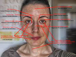 It flavors food and is a deficiency of sodium in the u.s. 24 Face Analysis Ideas Tissue Salts Homeopathy Facial Signs