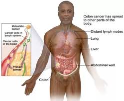 Image result for Colorectal Cancer