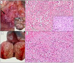 Maybe you would like to learn more about one of these? Diagnostics Free Full Text A Single Liver Metastasis From Pleural Biphasic Mesothelioma Html