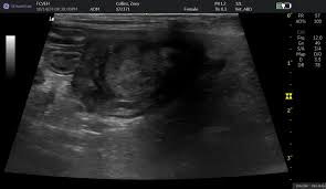 Image result for Retained Placenta