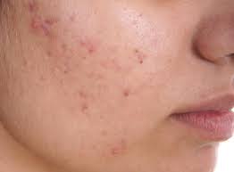 If your acne is severe or appears on your chest and back, it may need to be treated with antibiotics or stronger creams that are only available on prescription. Acne Causes Treatment And Tips