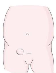 Image result for Inguinal hernia child