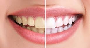 Rumor has it that some celebrities whiten their teeth with healthy foods like strawberries. How White Should My Teeth Really Be