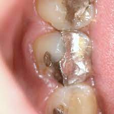 Should You Replace Old Black Fillings With White Fillings