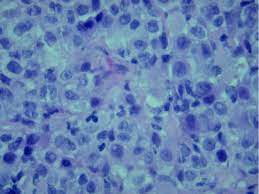 Maybe you would like to learn more about one of these? An Ema Negative Desmin Positive Malignant Mesothelioma Limitations Of Immunohistochemistry Journal Of Clinical Pathology