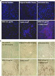 The tricolor ribbon is most broadly utilized for bladder cancer in the united states. Oncolytic Immunotherapy For Bladder Cancer Using Coxsackie A21 Virus Molecular Therapy Oncolytics