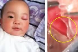 Masih banyak orang yang menganggap sepele mata merah. Menakutkan Ada 10 Cacing Di Mata Seorang Balita Ternyata Salah Satunya Tak Lakukan Ini Sebelum Makan Semua Halaman Sajian Sedap