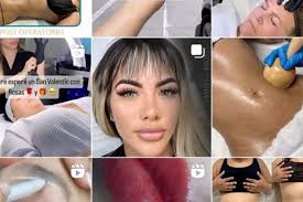 Lip Augmentation Near Me in Hollywood