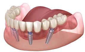 The Ultimate Guide to Dental Implants | Dental Implants Midtown Manhattan