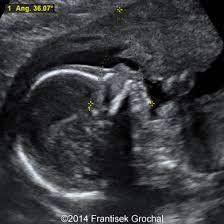 Treacher Collins Syndrome Role Of 3d 4d Ultrasound In The Assessment Of Fetal Facial Dysmorphism Html