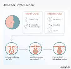Was Hilft Gegen Akne Bei Erwachsenen