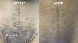 This is a form of vitamin a drug which helps renew the skin. Ingrown Hair Removal Pulse Light Clinic London