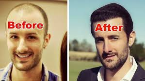 Fue is the modern approach to hair transplants and is usually favoured by patients because it leaves less obvious scarring. Hair Weaving Before And After
