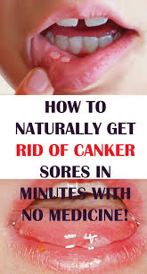 What Is A Canker Sore Have You Ever Had A Sore In Your Mouth That Hurt Pretty Bad Did It Take Forever To Go Away Alum For Canker Sores Canker Sore