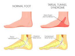 Tarsal Tunnel Syndrome Highgate Podiatry Biomechanics Orthotic Insole