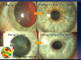What Is Corneal Scarring?