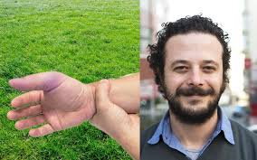 Park Cricketer Chalks Up Crippling Pain From Obvious Broken Hand To Just  Being Older Now — The Betoota Advocate