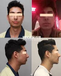 Regen Plastic Surgery Regen Plastic Surgery Instagram Photos And Videos Forehead Reduction Plastic Surgery Male Plastic Surgery