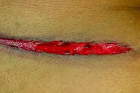 The mechanism of formation of the injury includes the compression of tissue. Gunshot Wound Deaths Springerlink