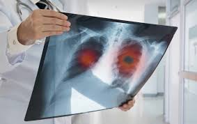 They can also show the size, shape, and position of any lung tumors and can help find enlarged lymph nodes that might contain cancer that has. Ecls Trial Shows Reduction In Late Stage Diagnoses Of Lung Cancer News The University Of Aberdeen