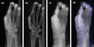 Photon Counting Spectral Basis Component Material Decomposition For Musculoskeletal Radiographs Scientific Reports
