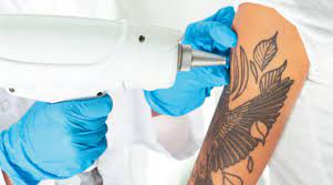 The theory is by using focused energy generated by a laser, tattoo ink particle is shattered into smaller tiny particles and can be removed by our own body, through lymphatic drainage systems. Relationship Between The Lymphatic System And Laser Tattoo Removal Fresh Skin Canvas