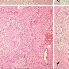 Pdf Differenzialdiagnostik Des Rheumatoiden Granuloms