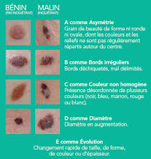 Pour un cancer de l'estomac. Comment Detecte T On Un Cancer De La Peau Depistage Des Cancers De La Peau