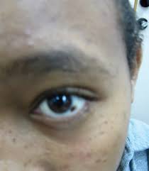 Image result for conjunctival melanoma