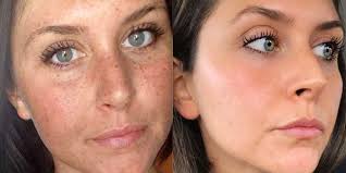 Has vitamin c, electrolytes & other nutrients. This Woman S Reddit Before And After Sun Damage Photo Is Going Viral