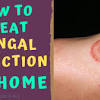 Despite its name, ringworm is not caused by a worm. Https Encrypted Tbn0 Gstatic Com Images Q Tbn And9gcrnketpju7q8vh9tsrui8jjkvnqtql1vh4ciicwqtpmld77 03w Usqp Cau