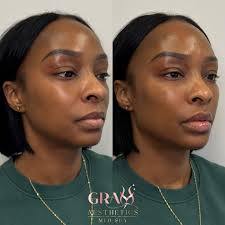 A little bit of 🪄 and a little bit of 💉 =full face rejuvenation. 🥰 My  goal is always to make you look natural, subtle, and youthful. NOT Overdone  or how social