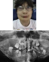 Cherubism: A Case Report of a Three-Generation Inheritance and Literature  Review